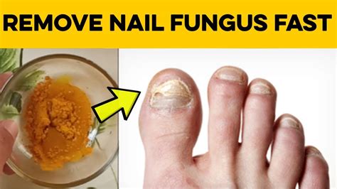 How To Cure Nail Fungus 2 Home Remedies For Toenail Fungus That