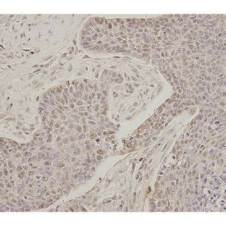 Expression Of TRIM24 Protein In Head And Neck Squamous Cell Carcinoma