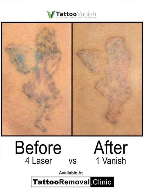 Tattoo Removal Before And After ️ Tattoo Removal Clinic
