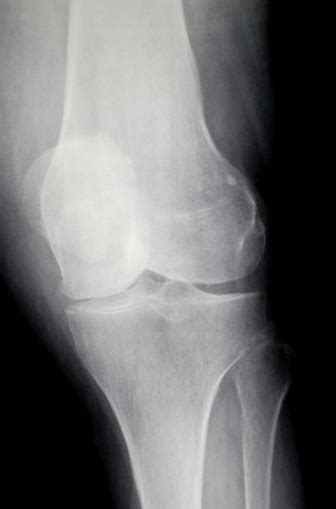 Xray Knee Oblique Stock Photo Download Image Now Color Image Data