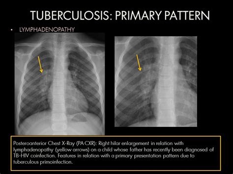 Pulmonary Tuberculosis Chest Xray Findings Image