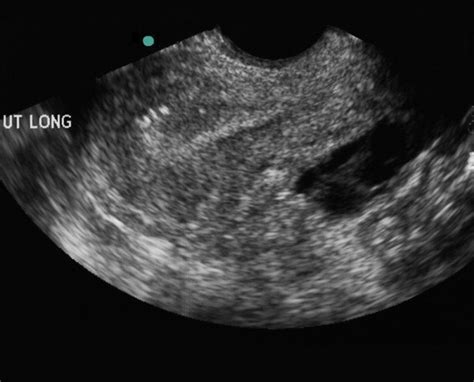 Sagittal View Of The Uterus On Trans Vaginal Ultrasound A Bulky