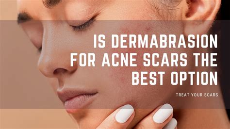 Is Dermabrasion For Acne Scars The Best Option Treat Your Scars