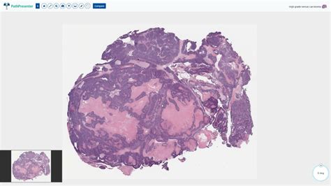 High Grade Serous Carcinoma Of The Ovary Histopathology Youtube