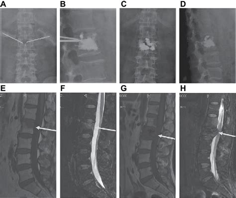 Group B Spinal Metastatic Tumor With Epidural Involvement Of L2