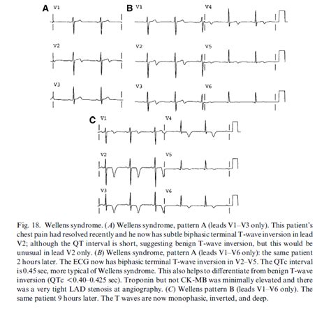 Dr Smiths Ecg Blog Why We Need Continuous 12 Lead St Segment