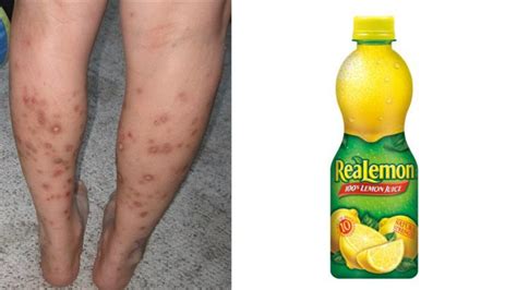 Red spots or patches on legs can appear in different forms. Home Remedies Series || Get Rid of Dark Spots On Legs ...