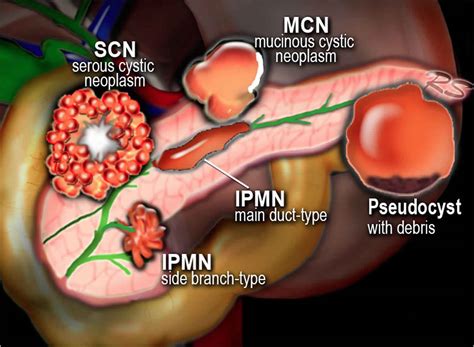Mucinous Cystic Neoplasm Pancreas Causes Symptoms Diagnosis