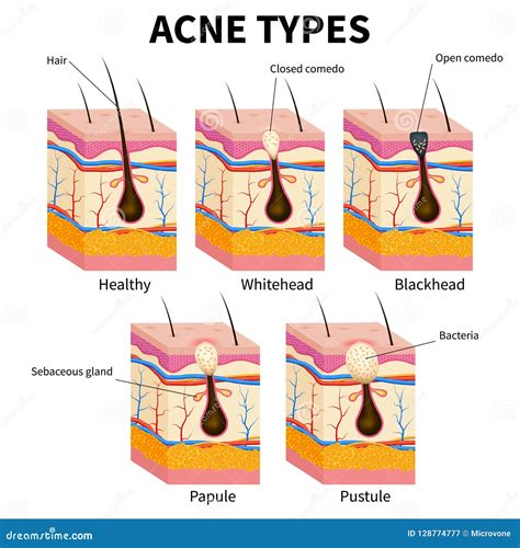 Tipos Da Acne Diagrama Médico Do Vetor Da Anatomia Das Doenças De Pele