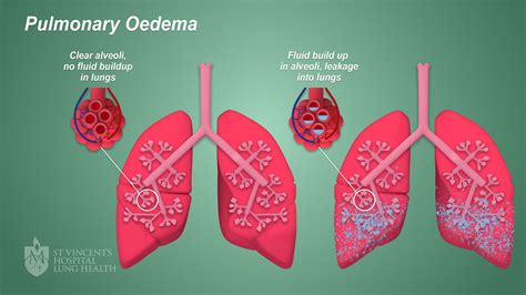 голям Ефективно универсален edema pulmonar chaleira a ferver неактивен
