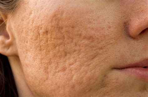 How To Get Rid Of Deep Acne Scars According To A Dermatologist