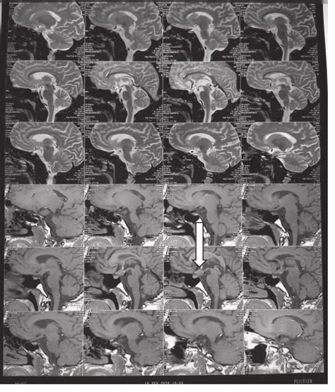 MRI Of Sellar And Parasellar Region T1 And T2 Weighted Image Sagital