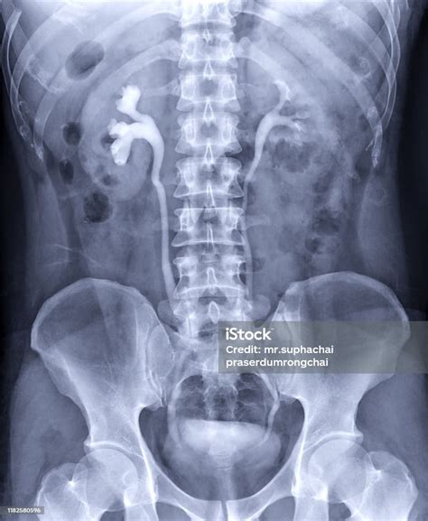 Intravenous Pyelogram Or Ivp Is An Xray Exam Of Urinary Tract After