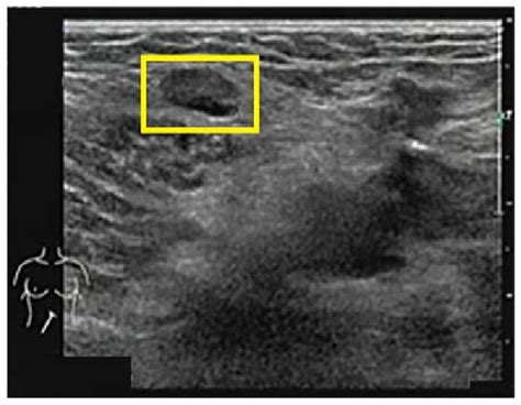 Ultrasound Scan Of The Right Groin Displaying An Enlarged Lymph Node