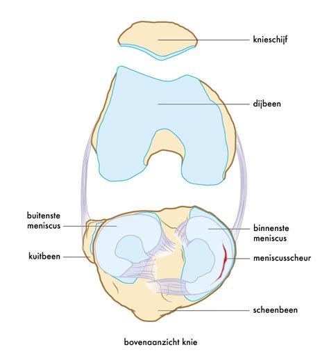 Hoe Lang Duurt Herstel Van Een Gescheurde Meniscus