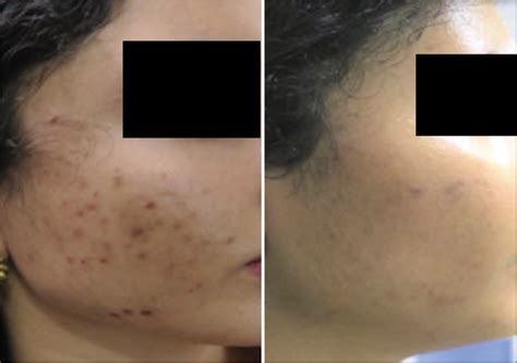 Tips For Managing Post Inflammatory Hyperpigmentation Of Acne Cosmoderma