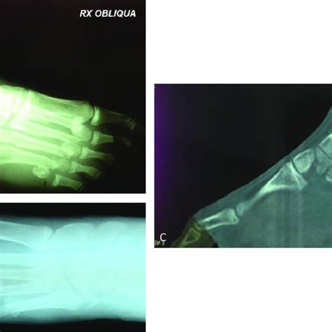 A Double Dorsal Incision Fasciotomy Over The Second To The Fourth