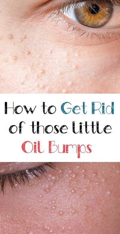 Get Rid Of Tiny Bumps On Face Get Rid Of Bumps