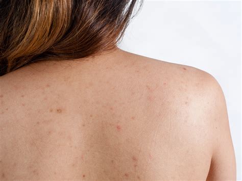 What Causes Acne On Your Back