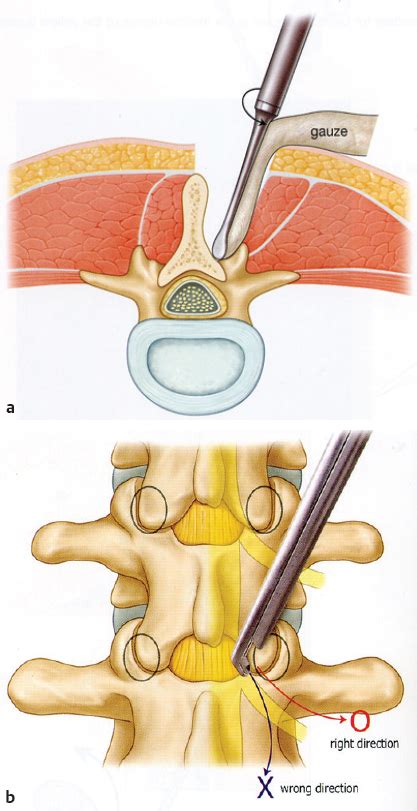 Minimally Invasive Tubular Decompression For Foraminal Stenosis