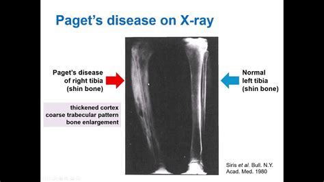 What Is Pagets Disease Of Bone And How Does Bisphosphonate Treatment