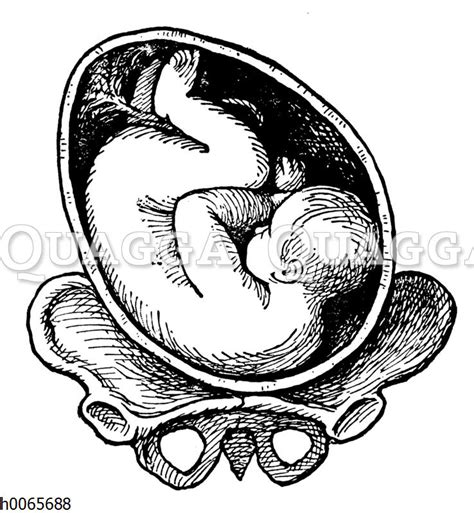 Die behandlung mit den größten heilungsaussichten ist eine operation, bei welcher der arzt die gebärmutter, eierstöcke und eileiter entfernt (hysterektomie). Lage eines Kindes in der Gebärmutter: Schulterlage ...