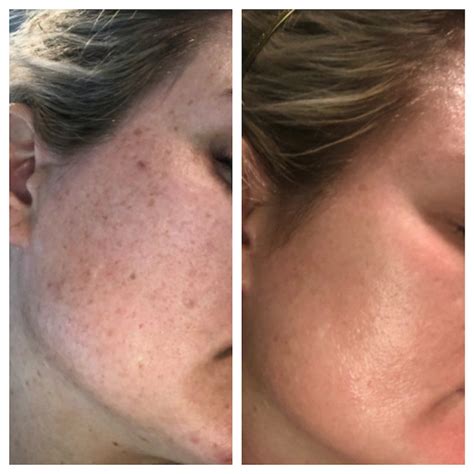 Cosmelan Treatment Results At Pfam Perfect Face Aesthetic Medicine