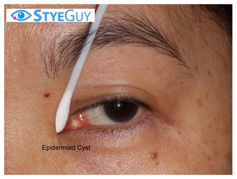 Stye Guy Epidermoid Cyst Styeguy