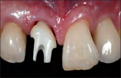 Placement Of The Custom Zirconia Abutment Note The Optimal Emergence Download Scientific
