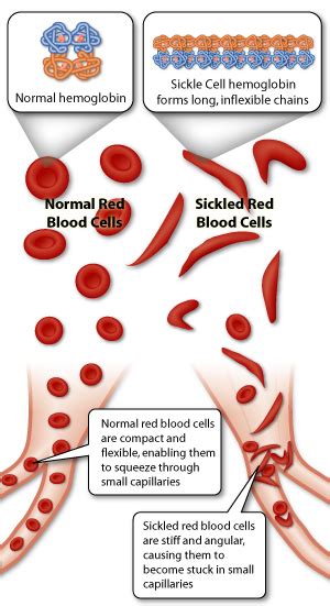 Sickle Cell Anemia Hematology Medbullets Step 1