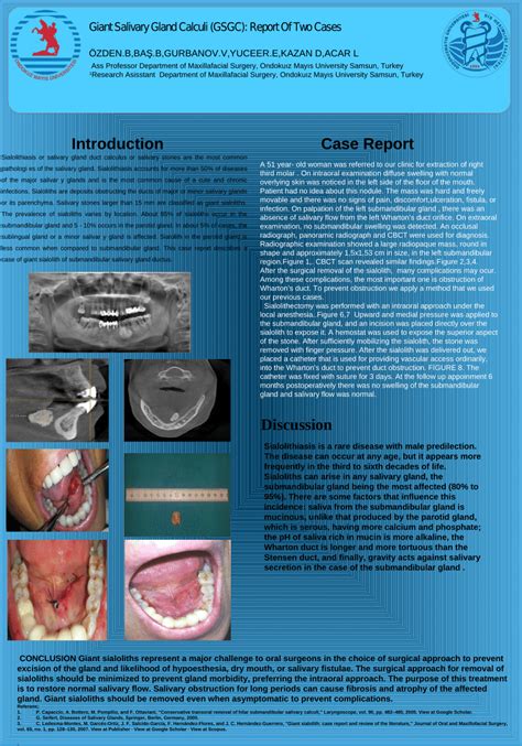 Pdf Giant Salivary Gland Calculi Gsgc Report Of Two Cases