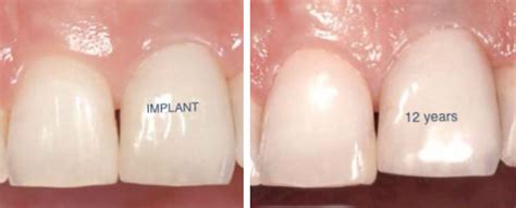 What Is The Best Age For A Dental Implant Enamor Dentistry
