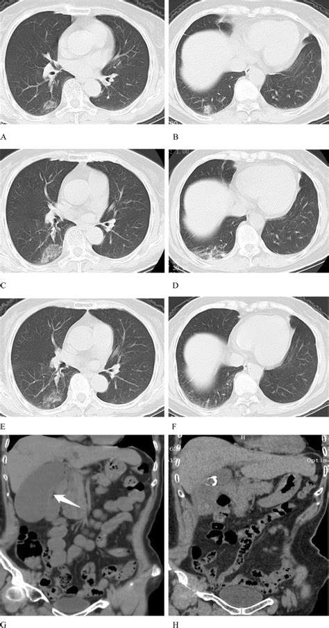 Chest And Abdominal Plain Ct Scans In A 68 Year Old Woman With Covid 19