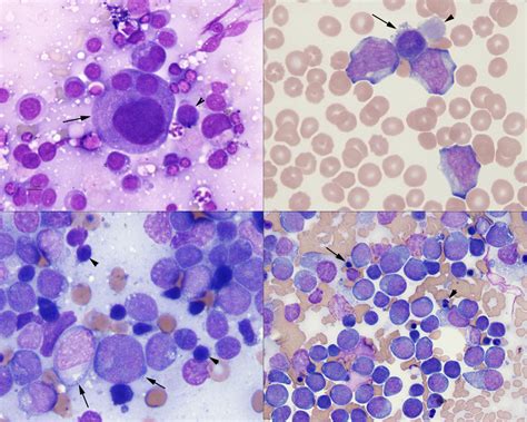 Myeloid Blasts In Various Samples Eclinpath