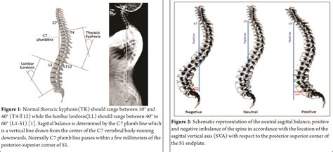 Positive Sagittal Balance And Management Strategies In Adult Spinal