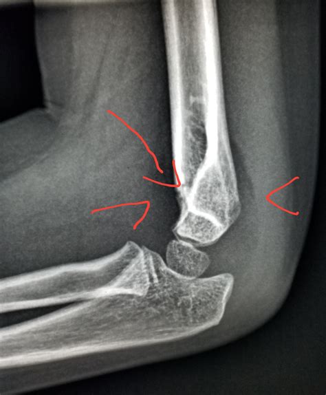 Elbow Xray Shows Fracture Arrow Suprachondylar With A Joint