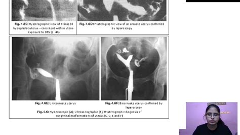 Vaginal Abnormalities Hematocolpus Hematometra Congenital