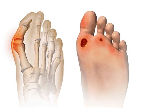 Diabetes Foot Ulcer Causes Symptoms Treatment हैलो स्वास्थ्य
