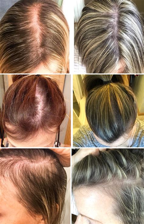 Women And Hair Loss Causes Solutions And Support — First Thyme Mom