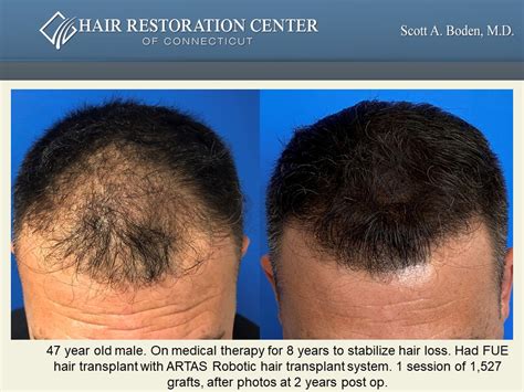 Fue Artas Robotic Hair Transplant Case Study Hair Restoration
