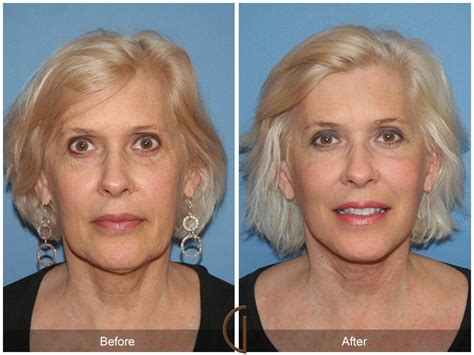 Neck Lift Before And After Photos Patient 81 Dr Kevin Sadati