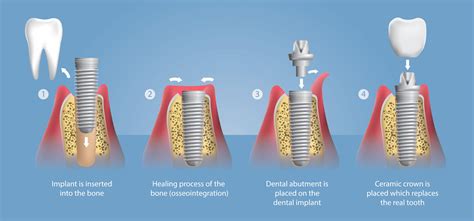 Dental Implants Smith And Van Lierop Dentistry