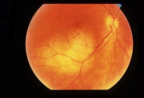 Amelanotic Malignant Melanoma Retina Image Bank