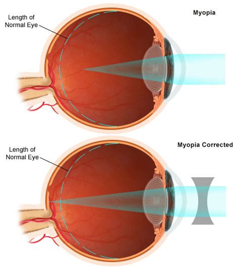 Human Eye And Defects Of Vision Science Vision