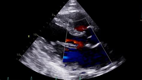 Flail Mitral Leaflet Youtube