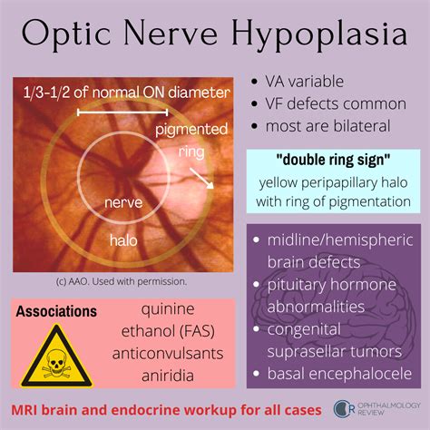Optic Nerve Hypoplasia — Ophthalmology Review