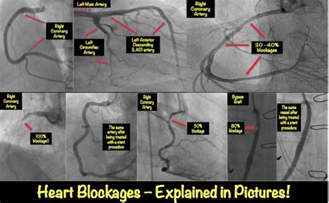 Average prices of more than 40 products and services in malaysia. Heart Blockage: Explained with Pictures • MyHeart