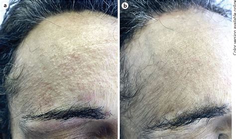 Figure From Successful Treatment Of Facial Papules In Frontal