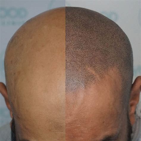 Impressive New Hair Loss Solution Scalp Micropigmentation Euroburn