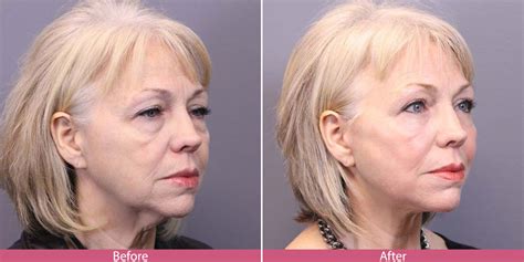 Jowls Before And After Weight Loss Before And After Weight Loss